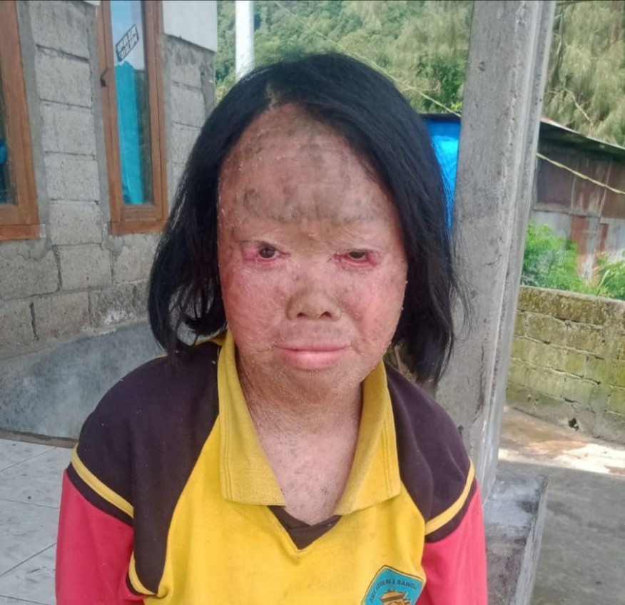 Dokumentasi dari - Mohon Uluran  Tangan Pemerintah, Dermawan Putu Malini Penderita Penyakit Kulit Melepuh dan Mengelupas 